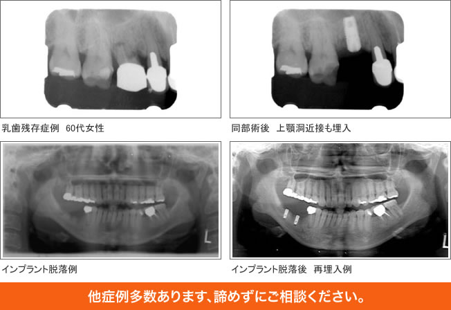 大畑歯科インプラントについて