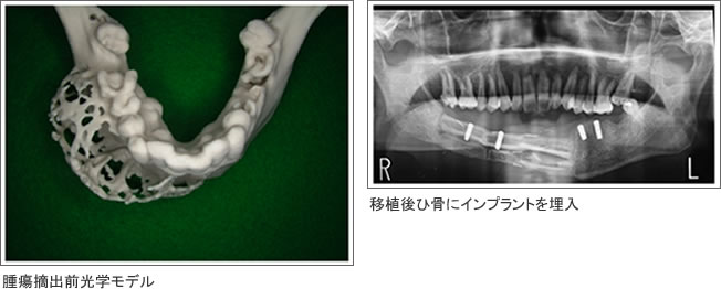 インプラント症例3