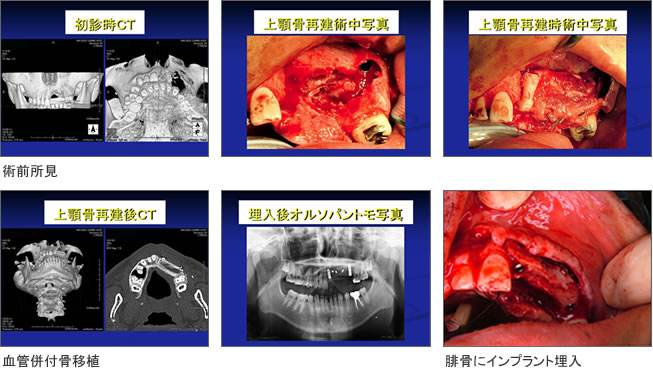 インプラント症例5