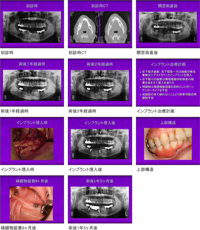インプラント症例4
